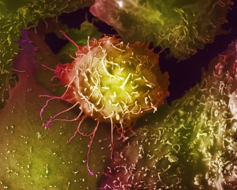 Prostate cancer screening should not be offered to most UK men, say experts